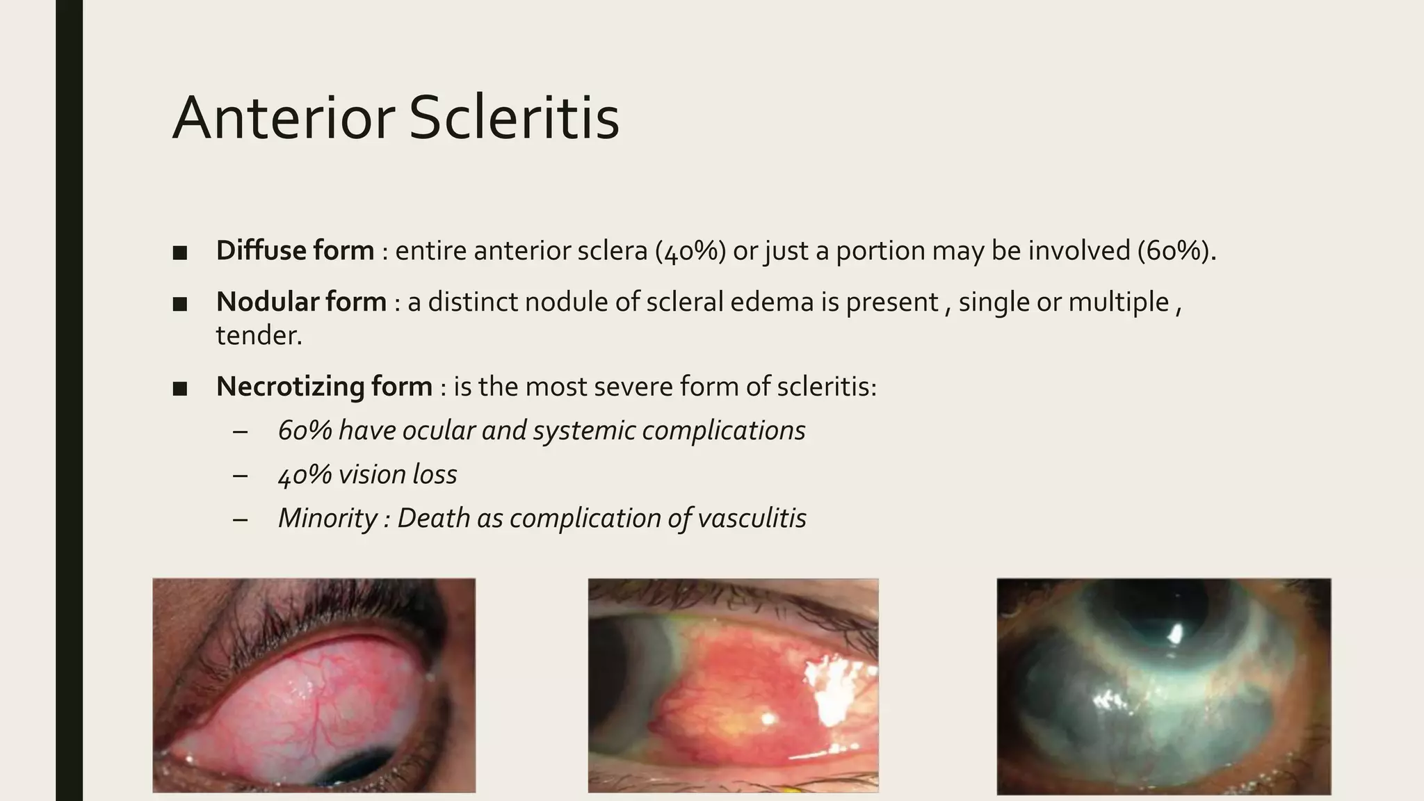 Scleritits. episcleritis | PPTX
