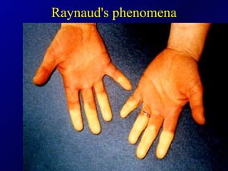 Raynaud's phenomena 