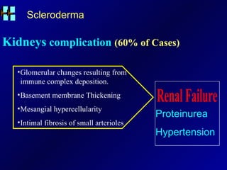 Scleroderma Kidneys  complication  (60% of Cases) Glomerular changes resulting from immune complex deposition. Basement membrane Thickening Mesangial hypercellularity Intimal fibrosis of small arterioles Renal Failure Proteinurea Hypertension 