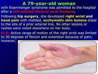 A 79-year-old woman with Eisenmenger syndrome was admitted to the hospital after a  fall-related femoral neck   fracture .   Following  hip surgery , she developed  right wrist  and   hand pain  with mottled,  ecchymotic skin lesions  distal to the site of a prior arterial line. No other lesions or rashes were noted elsewhere on her body.  O/E:  Active range of motion of the right wrist was limited to 30 degrees of flexion and extension because of pain; however,  