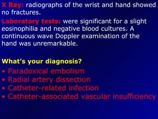 X Ray:  radiographs of the wrist and hand showed no fractures.  Laboratory tests:  were significant for a slight eosinophilia and negative blood cultures. A continuous wave Doppler examination of the hand was unremarkable.  What’s your diagnosis? •  Paradoxical embolism • Radial artery dissection • Catheter-related infection • Catheter-associated vascular insufficiency 