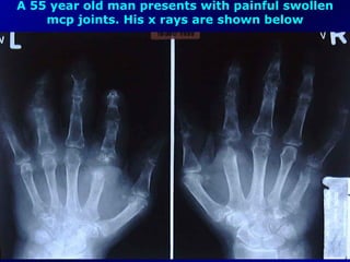 A 55 year old man presents with painful swollen mcp joints. His x rays are shown below 