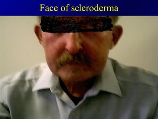 Face of scleroderma 