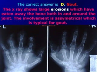 The correct answer is   D .  Gout .   The x ray shows large  erosions  which have eaten away the bone both in and around the joint. The involvement is assymetrical which is typical for gout.  