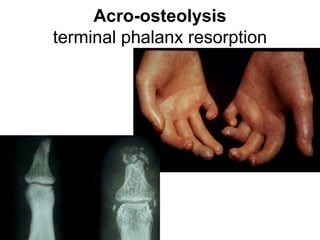 Acro-osteolysis
terminal phalanx resorption
 