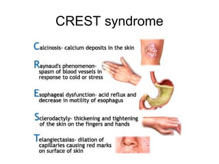 CREST syndrome
 