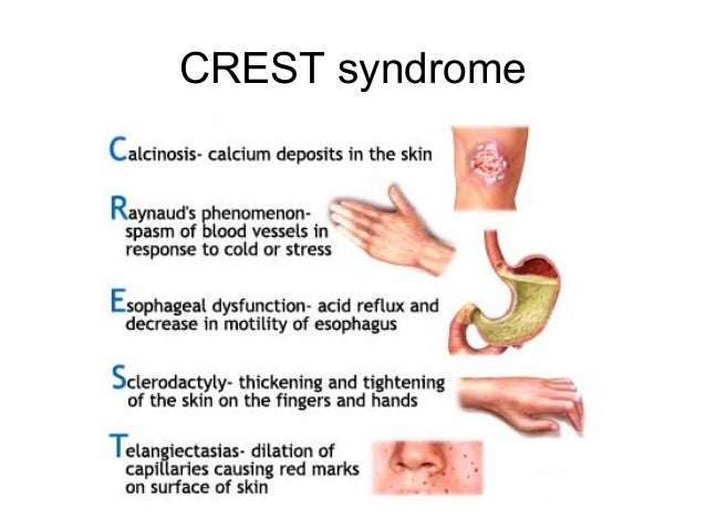 Scleroderma scleroderma