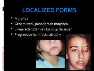 LOCALIZED FORMS
 Morphea
 Generalized / pansclerotic morphea
 Linear scleroderma - En coup de saber
 Progressive hemifacial atrophy
 