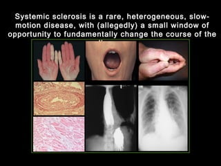 Systemic sclerosis is a rare, heterogeneous, slow-
motion disease, with (allegedly) a small window of
opportunity to fundamentally change the course of the
disease.
 