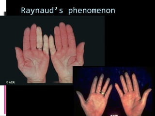 Raynaud’s phenomenon
 