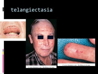 telangiectasia
 