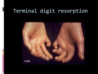 Terminal digit resorption
 