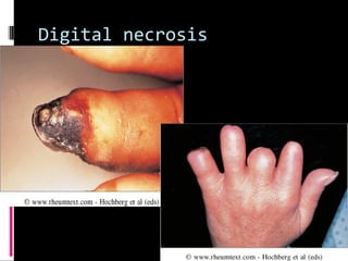 Digital necrosis
 