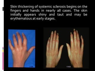 Skin thickening of systemic sclerosis begins on the
fingers and hands in nearly all cases. The skin
initially appears shiny and taut and may be
erythematous at early stages.
 