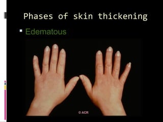 Phases of skin thickening
 Edematous
 
