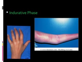  Indurative Phase
 