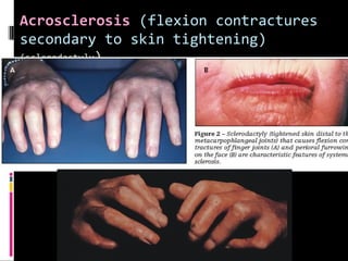 Acrosclerosis (flexion contractures
secondary to skin tightening)
(sclerodactyly)
 