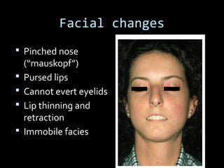 Facial changes
 Pinched nose
(“mauskopf”)
 Pursed lips
 Cannot evert eyelids
 Lip thinning and
retraction
 Immobile facies
 