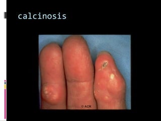 calcinosis
 