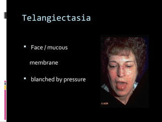 Telangiectasia
 Face / mucous
membrane
 blanched by pressure
 
