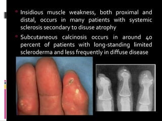  Insidious muscle weakness, both proximal and
distal, occurs in many patients with systemic
sclerosis secondary to disuse atrophy
 Subcutaneous calcinosis occurs in around 40
percent of patients with long-standing limited
scleroderma and less frequently in diffuse disease
 
