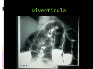 Diverticula
 