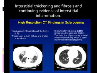 Interstitial thickening and fibrosis and
continuing evidence of interstitial
inflammation.
 