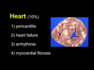 Heart (10%)
1) pericarditis
2) heart failure
3) arrhythmia
4) myocardial fibrosis
 