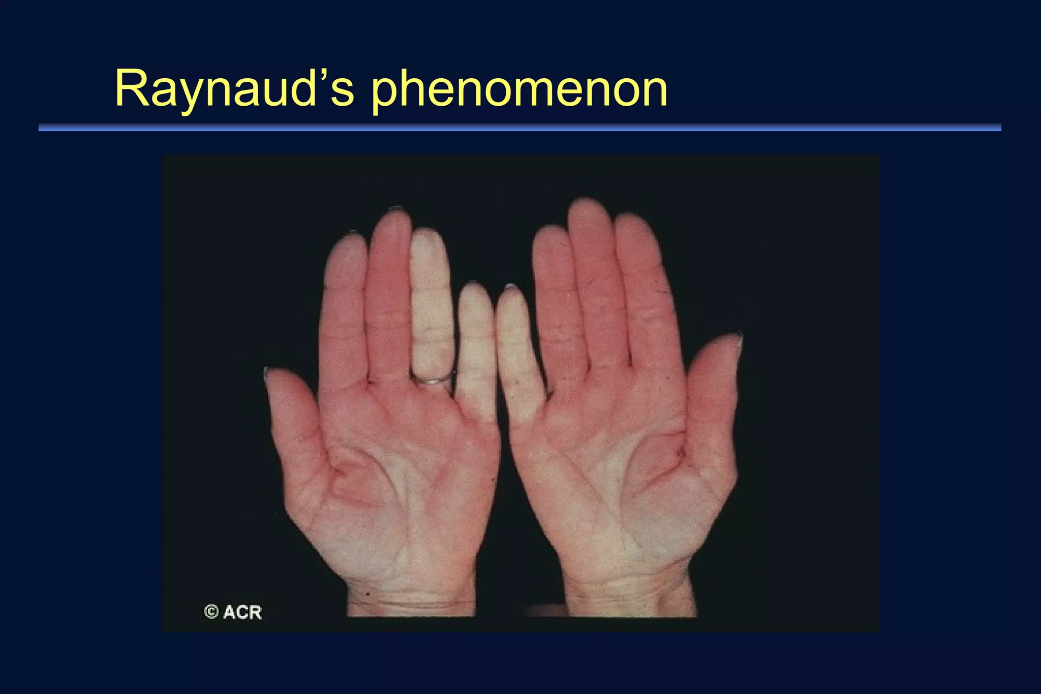 Raynaud’s phenomenon 
 