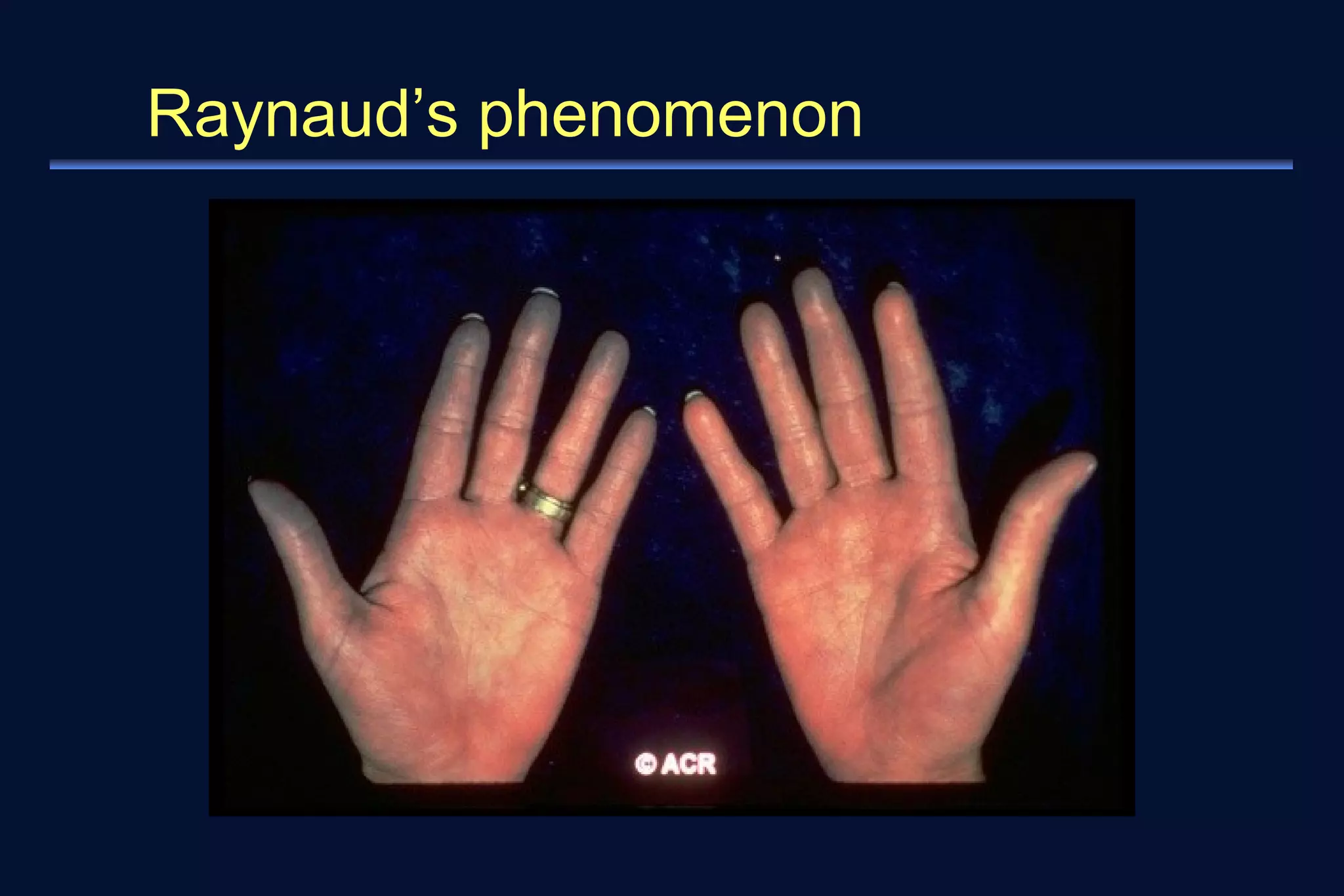 Raynaud’s phenomenon 
 