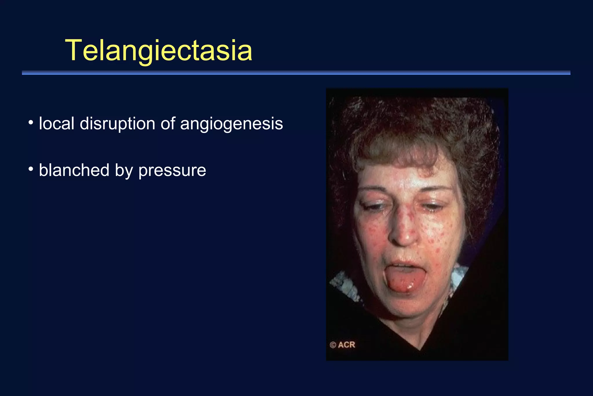 Telangiectasia 
• local disruption of angiogenesis 
• blanched by pressure 
 