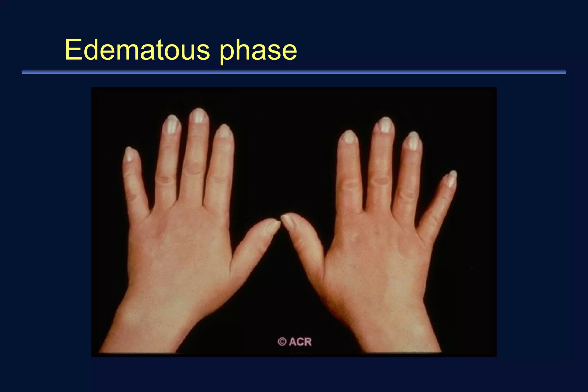 Edematous phase 
 