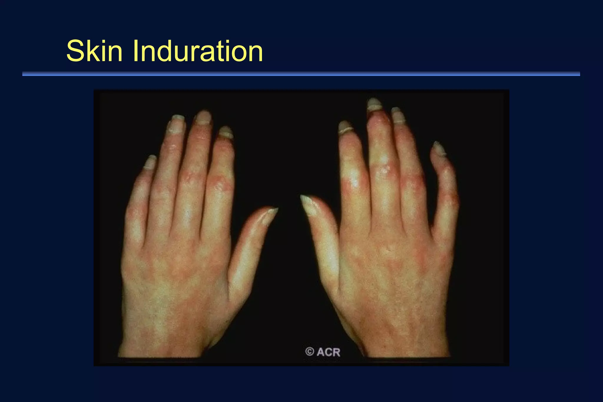 Skin Induration 
 