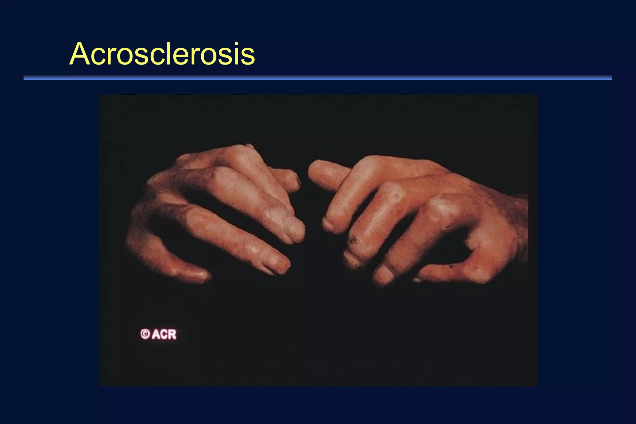 Acrosclerosis 
 
