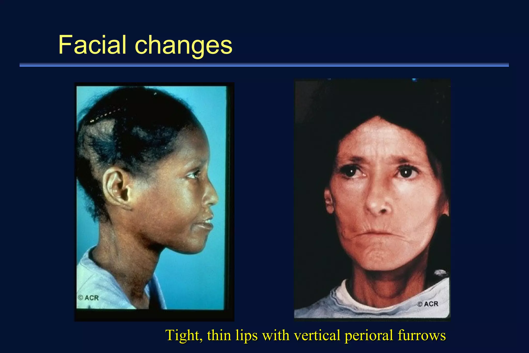 Facial changes 
Tight, thin lips wwiitthh vveerrttiiccaall ppeerriioorraall ffuurrrroowwss 
 