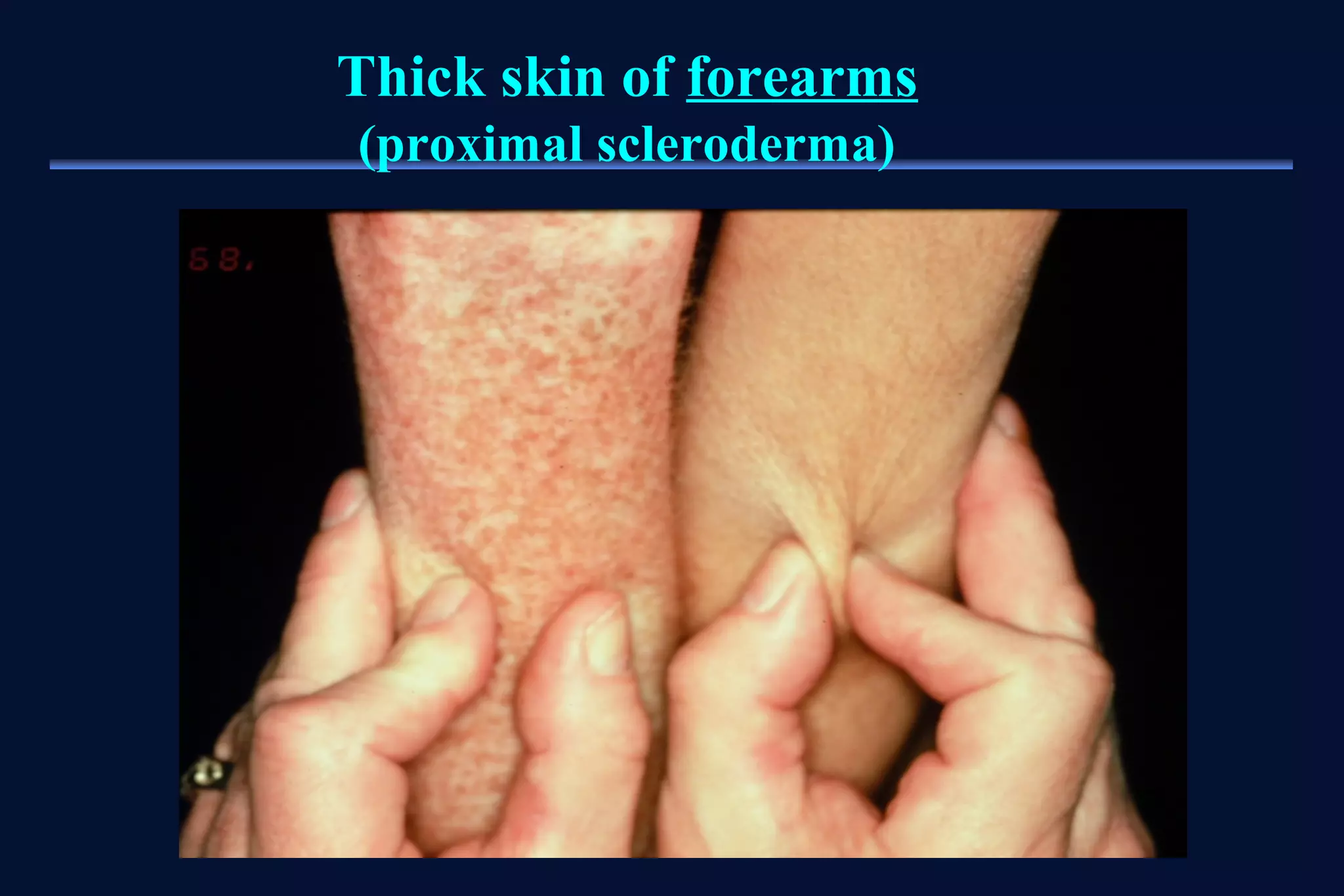 Thick skin of forearms 
(proximal scleroderma) 
 