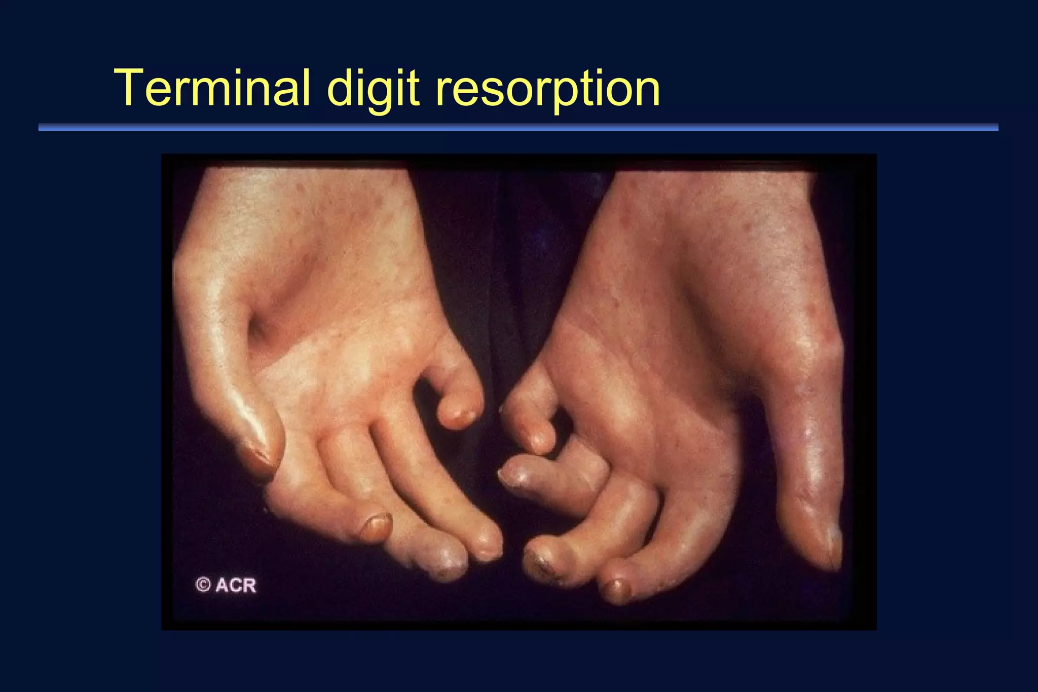 Terminal digit resorption 
 
