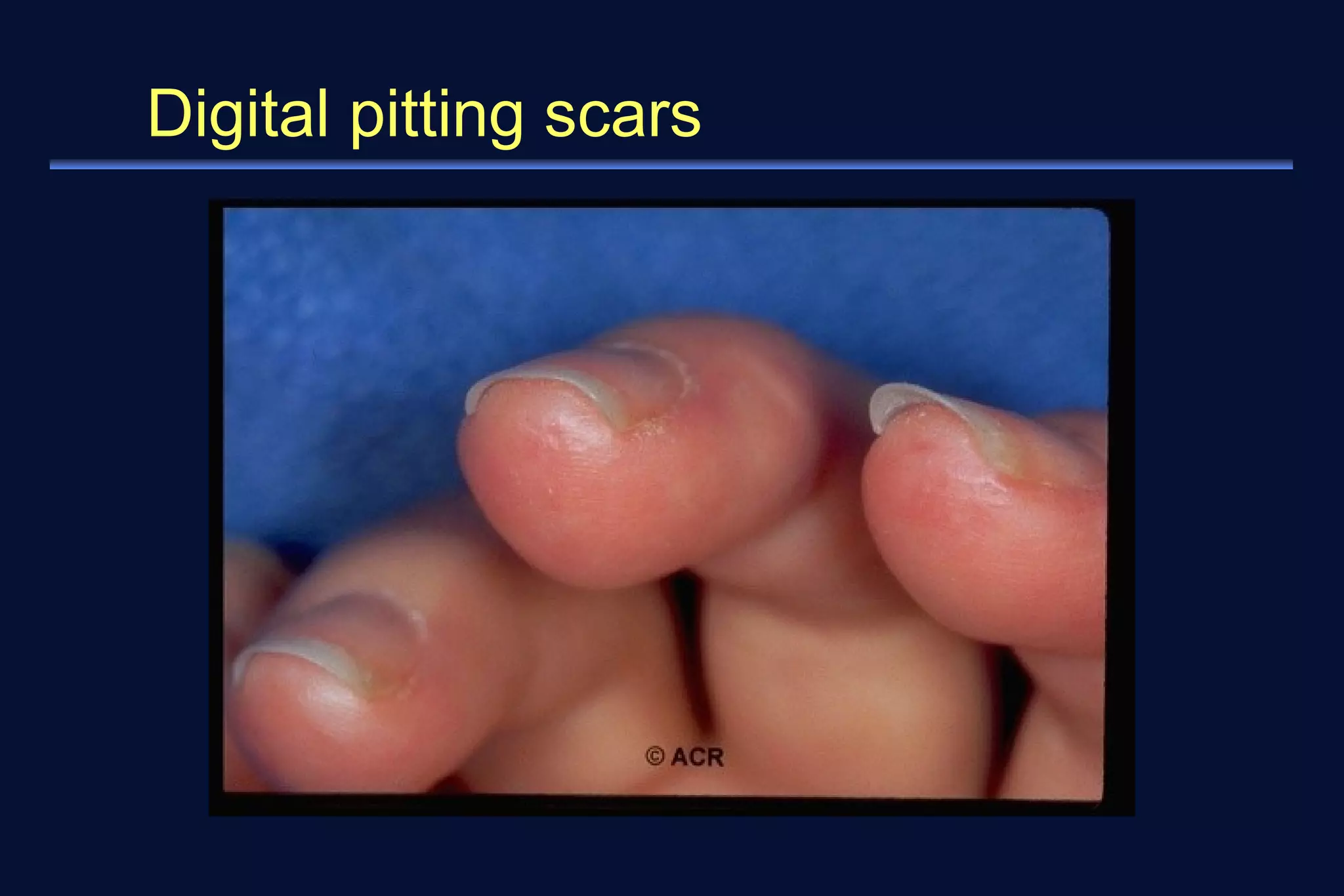 Digital pitting scars 
 