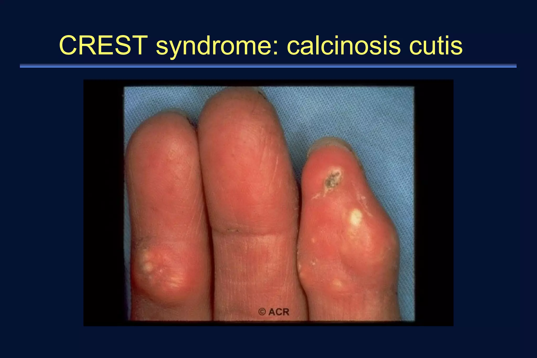 CREST syndrome: calcinosis cutis 
 