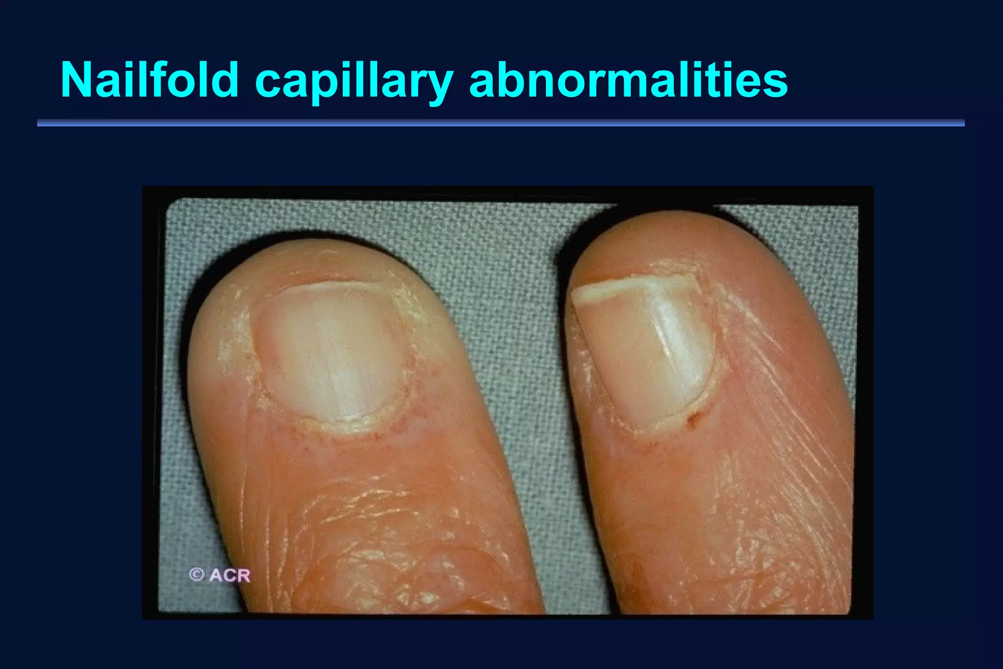 Nailfold capillary abnormalities 
 