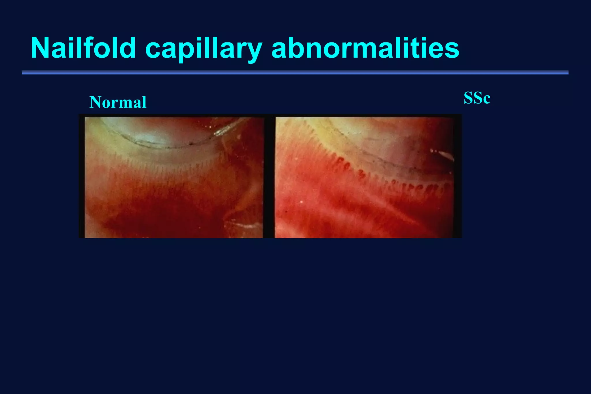 Nailfold capillary abnormalities 
Normal SSc 
 