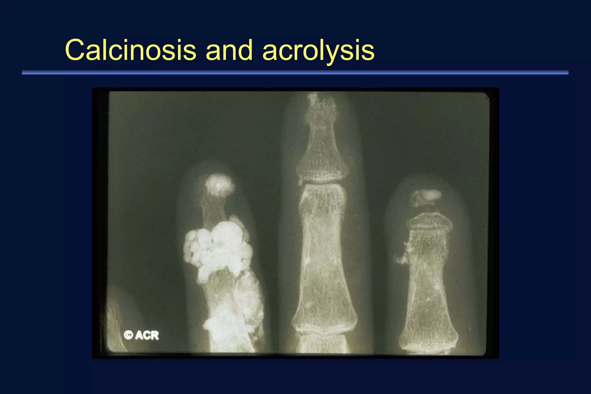 Calcinosis and acrolysis 
 