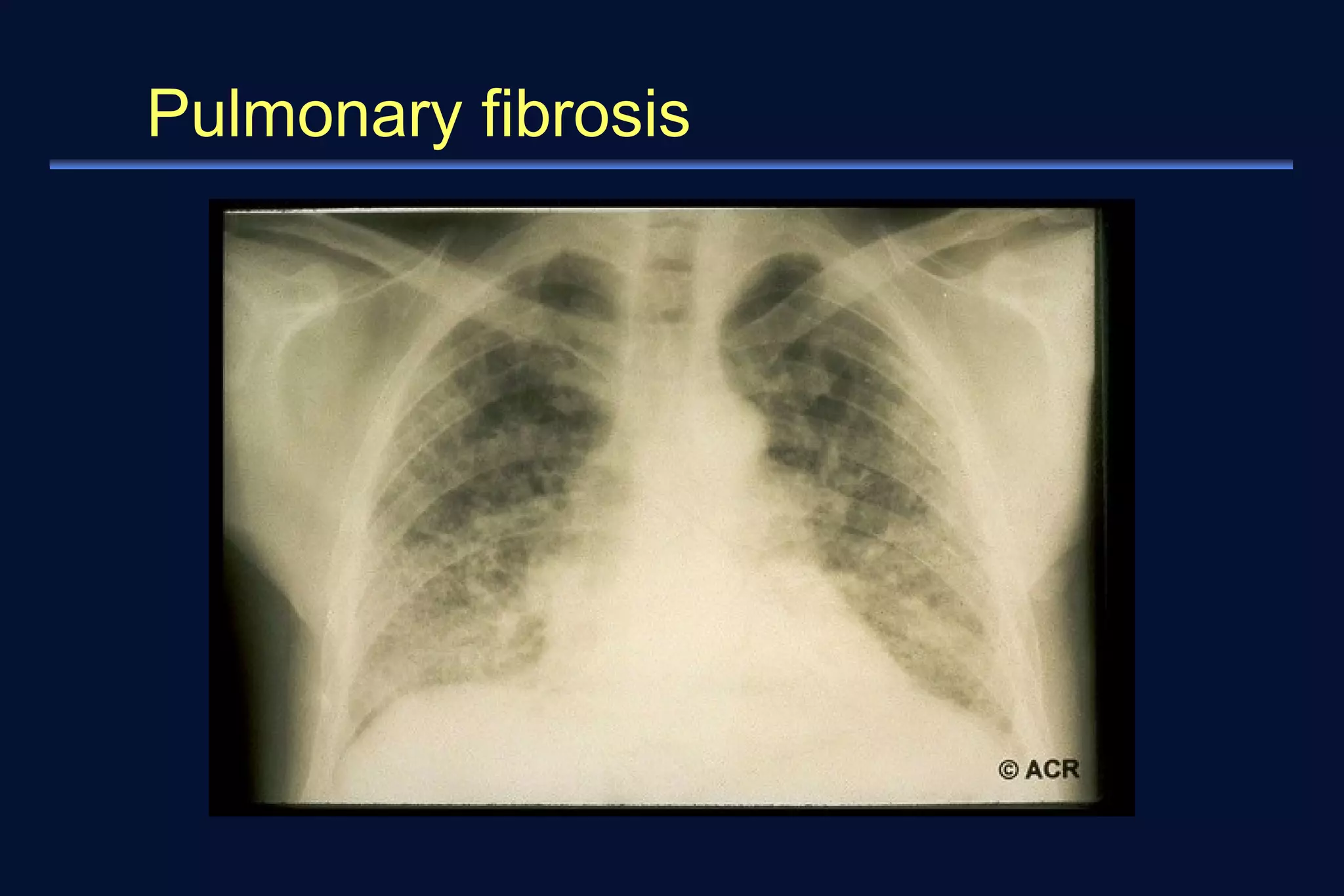Pulmonary fibrosis 
 