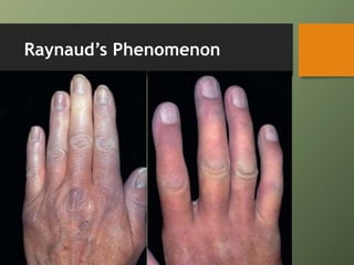 Raynaud’s Phenomenon
 