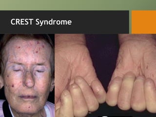 CREST Syndrome
 