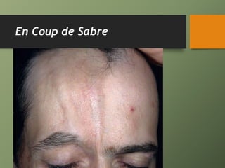 En Coup de Sabre
 