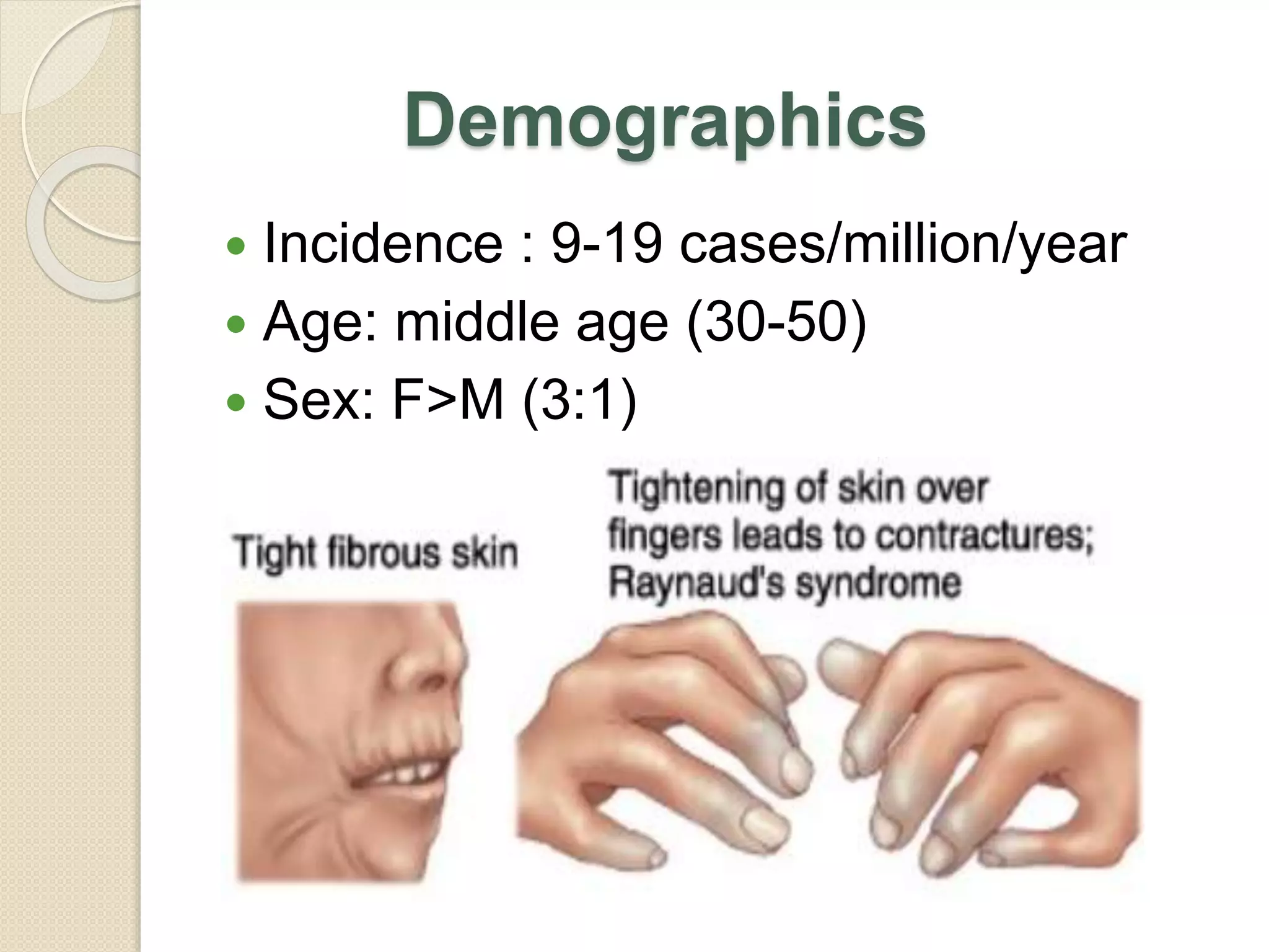 Demographics
 Incidence : 9-19 cases/million/year
 Age: middle age (30-50)
 Sex: F>M (3:1)
 
