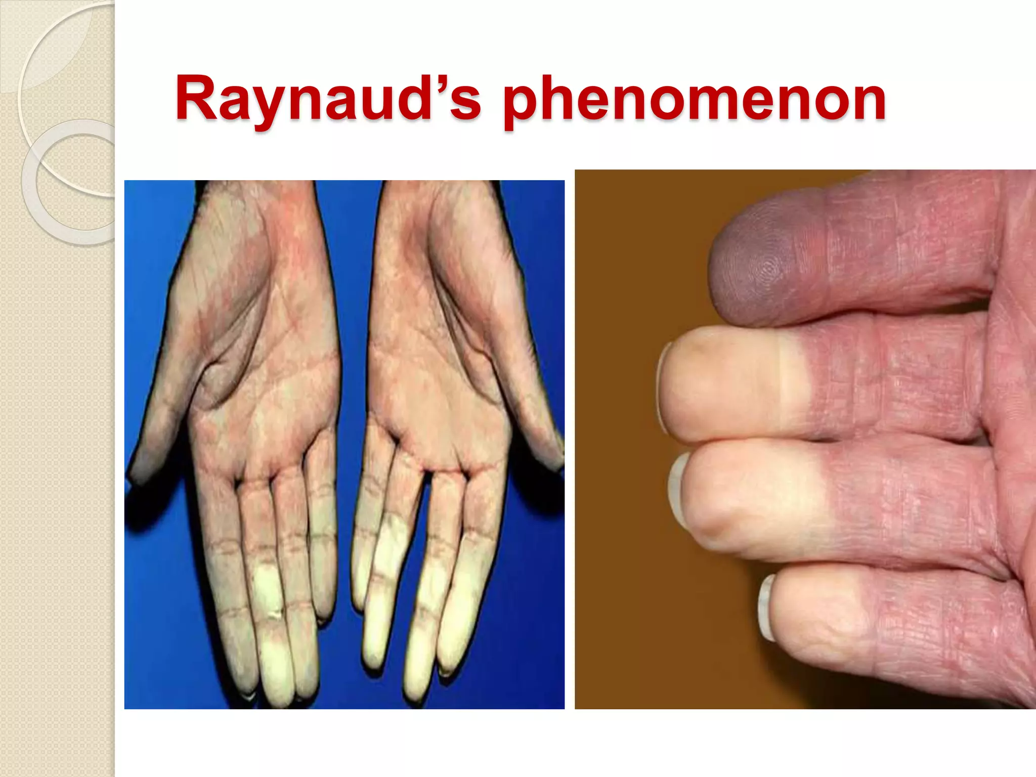 Raynaud’s phenomenon
 