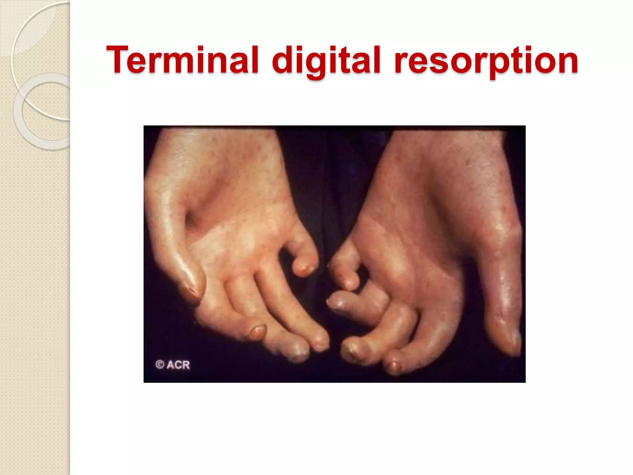 Terminal digital resorption
 