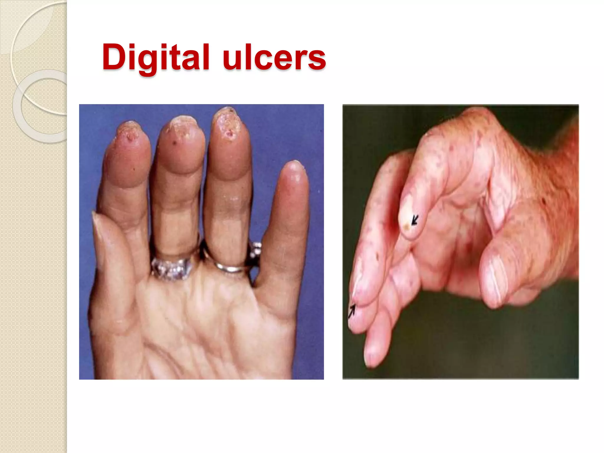Digital ulcers
 